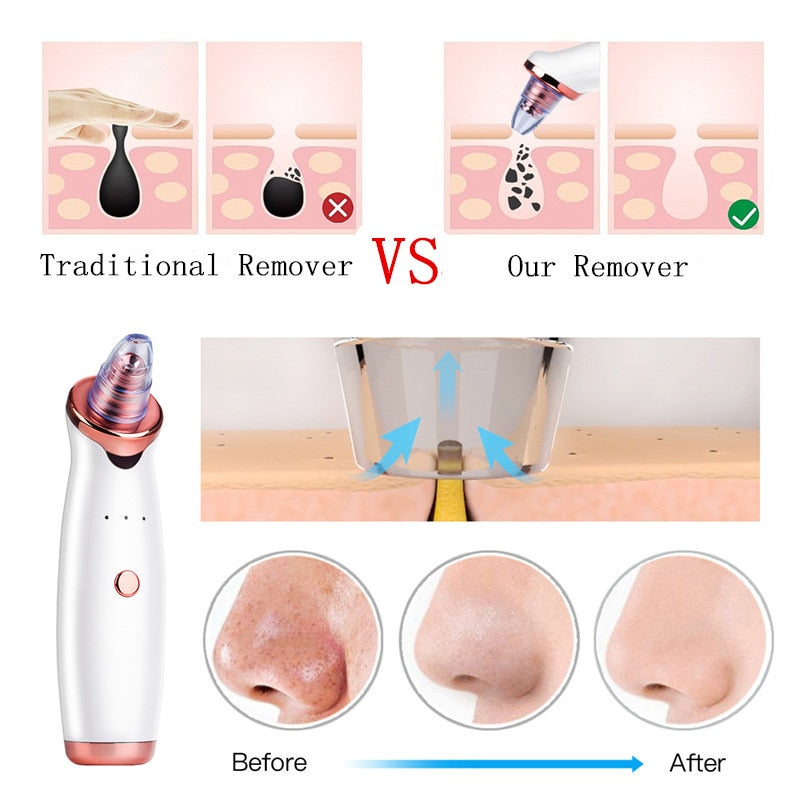 BLACKHEAD REMOVER